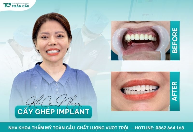 Khách hàng đã cấy implant thành công tại Nha khoa Thẩm mỹ Toàn cầu