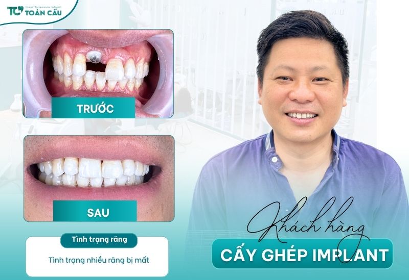 Dịch vụ cấy ghép implant tại Nha khoa Thẩm mỹ Toàn Cầu