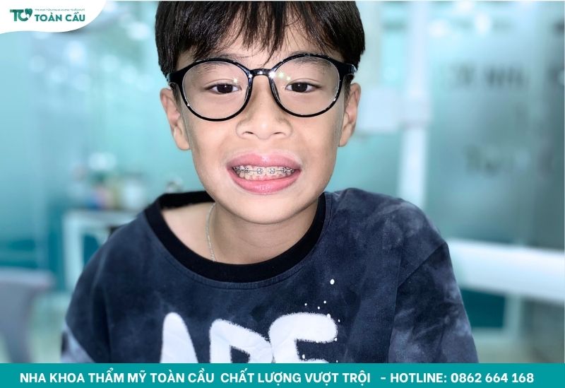 Giải đáp bao nhiêu tuổi có thể niềng răng 