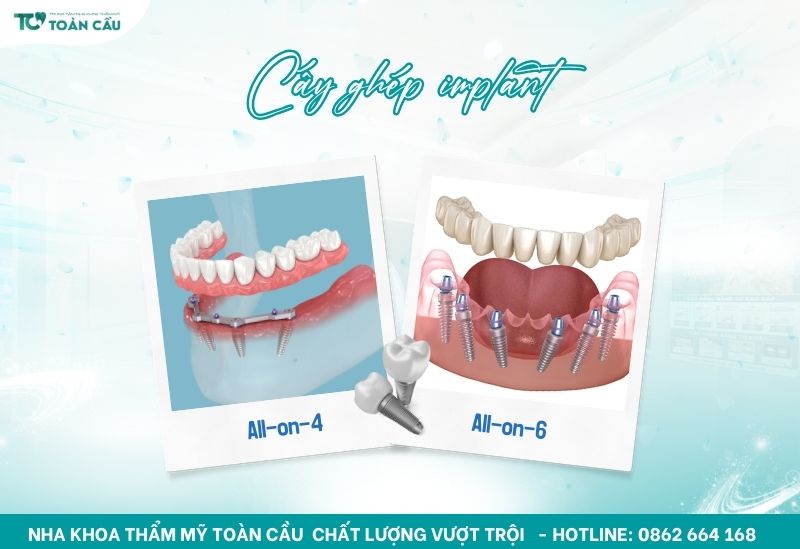 Kỹ thuật cấy ghép implant All-on-4 và All-on-6