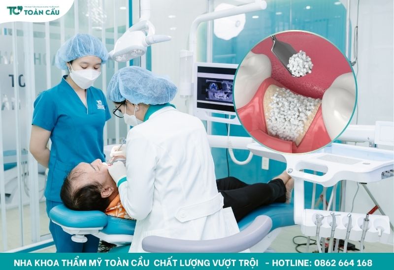 Trường hợp nào cần ghép xương trong trồng răng implant 5 Ghép xương răng là kỹ thuật nha khoa tiên tiến