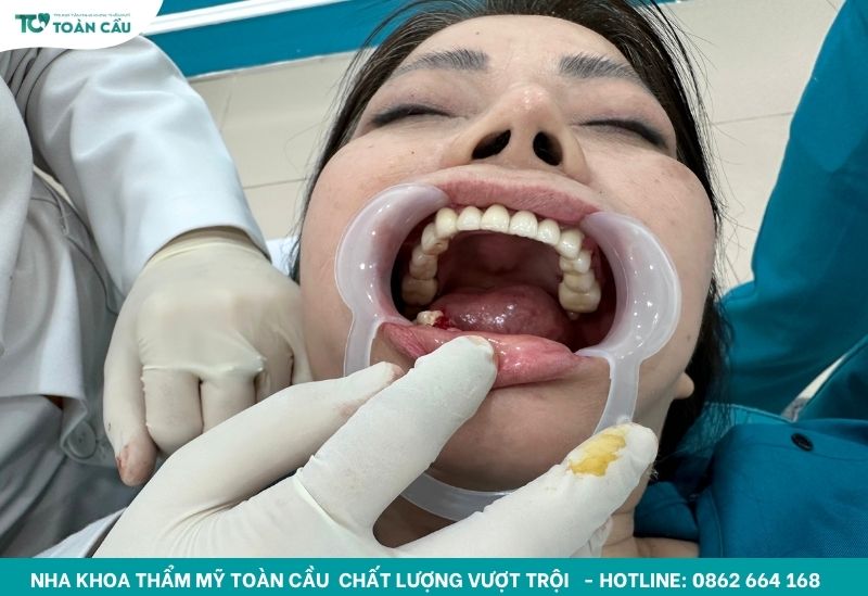 Trường hợp nào cần ghép xương trong trồng răng implant 6 Mất răng lâu ngày gây tiêu xương