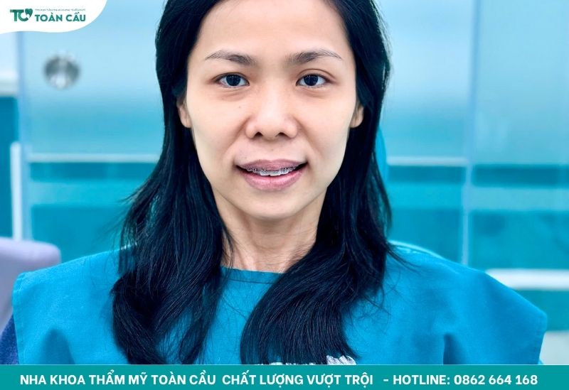 Chuyên gia giải đáp: Niềng răng giá rẻ có thực sự hiệu quả? 5 Nhu cầu niềng răng để cải thiện nụ cười ngày càng tăng cao