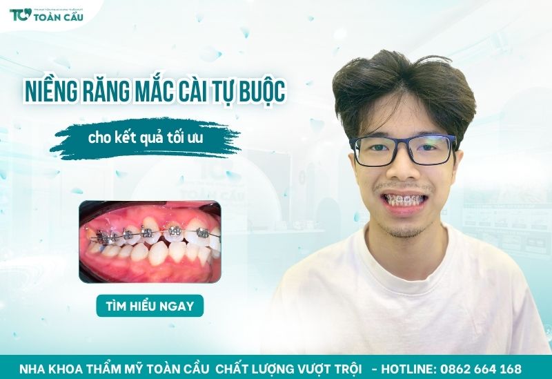 Niềng răng mắc cài tự buộc là gì