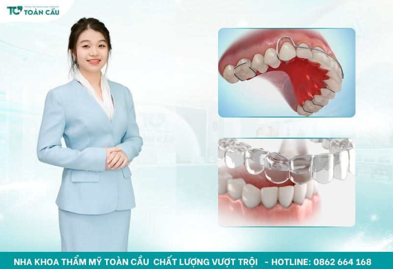 Niềng răng tháo lắp có hiệu quả không? Ai nên chọn phương pháp này 5 Các loại niềng răng tháo lắp phổ biến hiện nay