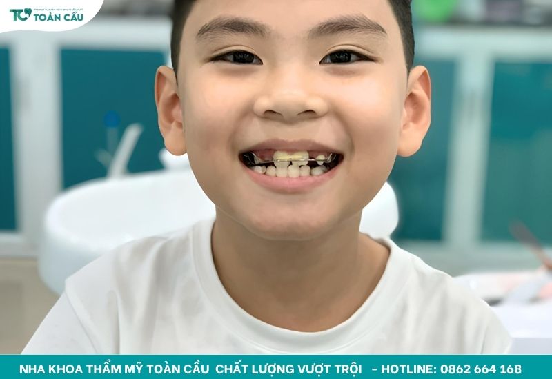 Niềng răng tháo lắp có hiệu quả không? Ai nên chọn phương pháp này 6 Trẻ em nên được chỉnh nha từ sớm