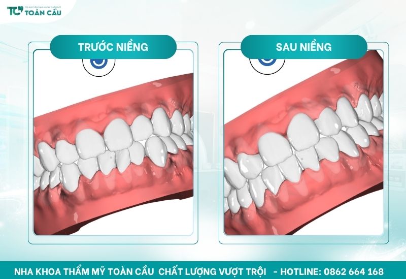 Niềng răng tháo lắp có hiệu quả không? Ai nên chọn phương pháp này 8 Hình ảnh 3D niềng răng trong suốt của khách hàng Bảo Ngân