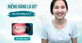 quy trình niềng răng từ A-Z