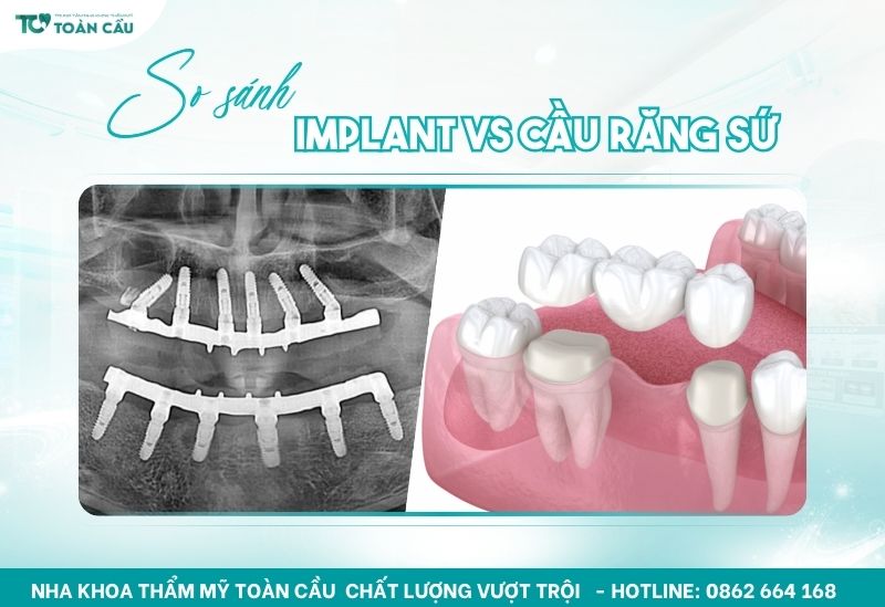 So sánh trồng răng implant và cầu răng sứ – Phương pháp nào tốt hơn? 7 So sánh trồng răng implant và cầu răng sứ