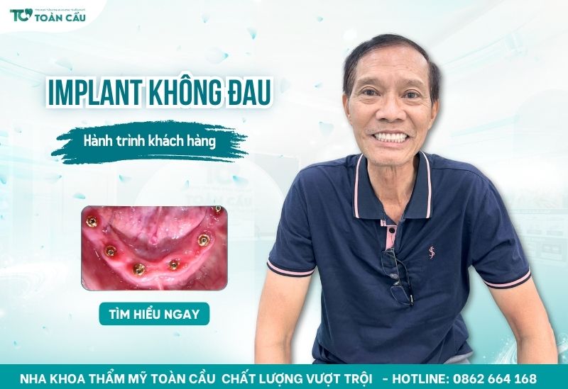 trải nghiệm trồng răng implant không đau