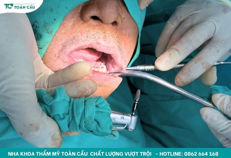 Trải nghiệm trồng răng implant không đau tại Gò Vấp – Hành trình khách hàng thực tế 5 Trải nghiệm trồng răng implant không đau tại Toàn Cầu