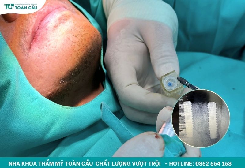Trải nghiệm trồng răng implant không đau tại Gò Vấp – Hành trình khách hàng thực tế 7 Chỉ từ 20 - 30 phút là trụ đã nằm chắc trong xương hàm
