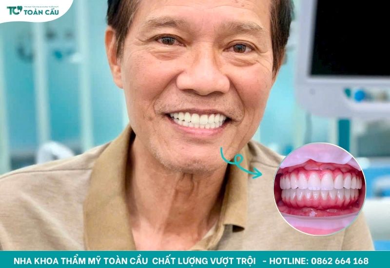 Trải nghiệm trồng răng implant không đau tại Gò Vấp – Hành trình khách hàng thực tế 8 Hoàn tất hành trình khi gắn răng sứ