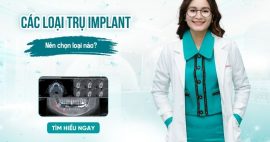 trụ implant phổ biến