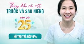trước và sau khi niềng răng