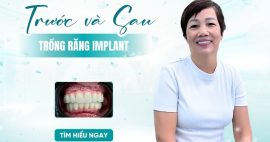 trước và sau khi trồng răng implant
