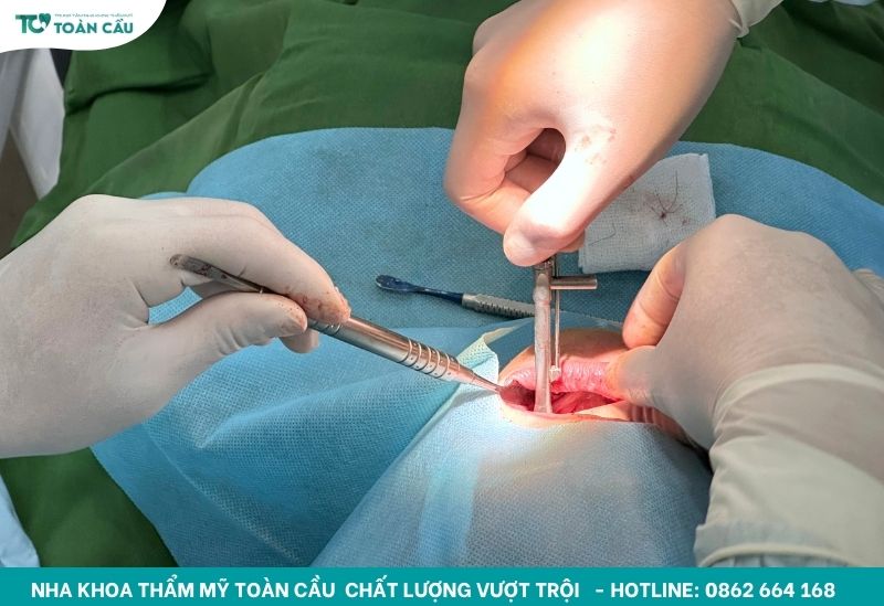 Cấy ghép implant an toàn tại Nha khoa Toàn Cầu