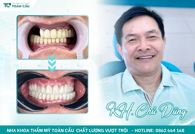 Khách hàng hài lòng khi cấy ghép implant tại Toàn Cầu
