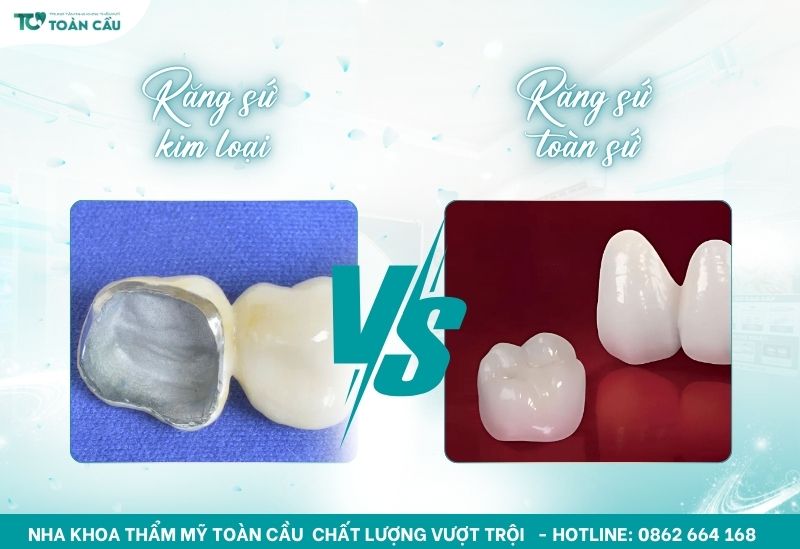 Mức giá bọc sứ có sự chênh lệch tùy vào loại răng sứ