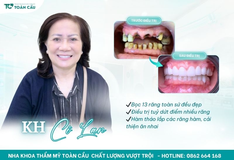 Địa chỉ bọc sứ Gò Vấp sẽ giúp bạn sở hữu nụ cười tự tin 7 Cô Lan bọc 13 răng toàn sứ đều đẹp