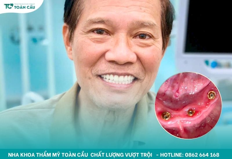 Địa chỉ trồng răng cho người lớn tuổi uy tín tại Gò Vấp 5 Để trống răng trong thời gian dài có thể gây ra nhiều hệ lụy