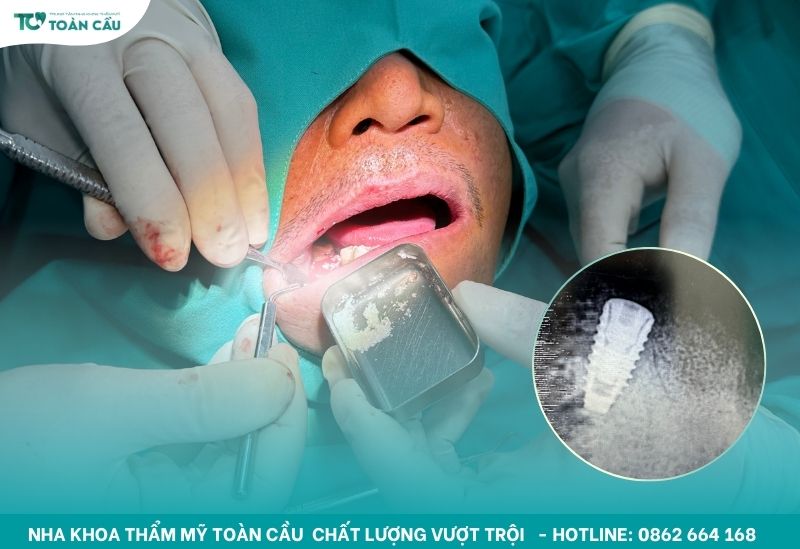 Địa chỉ trồng răng cho người lớn tuổi uy tín tại Gò Vấp 6 Cấy ghép implant là phương pháp hiện đại nhất