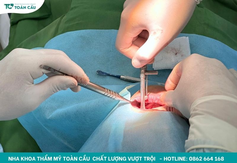 Không phải lúc nào implant đắt tiền nhất cũng là tốt nhất