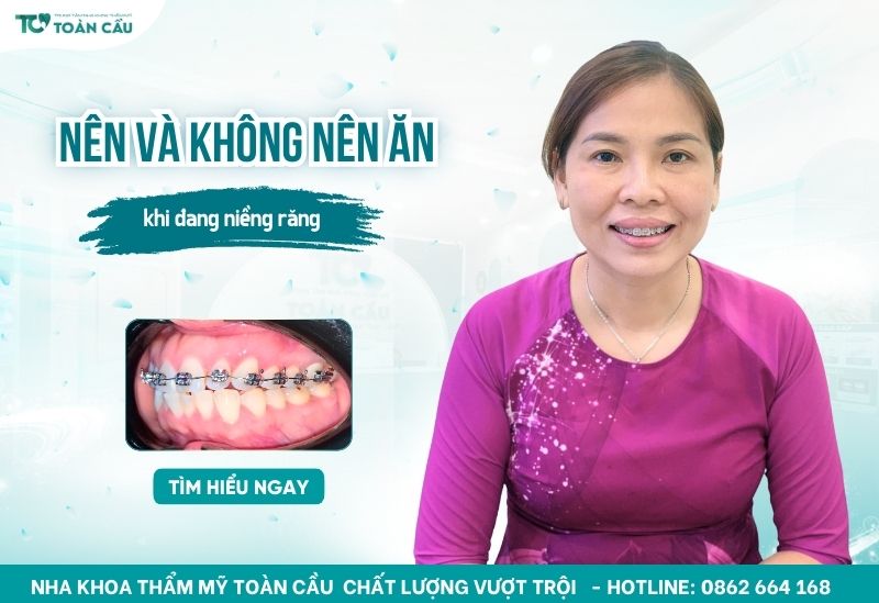 nên và không nên ăn khi đang niềng răng