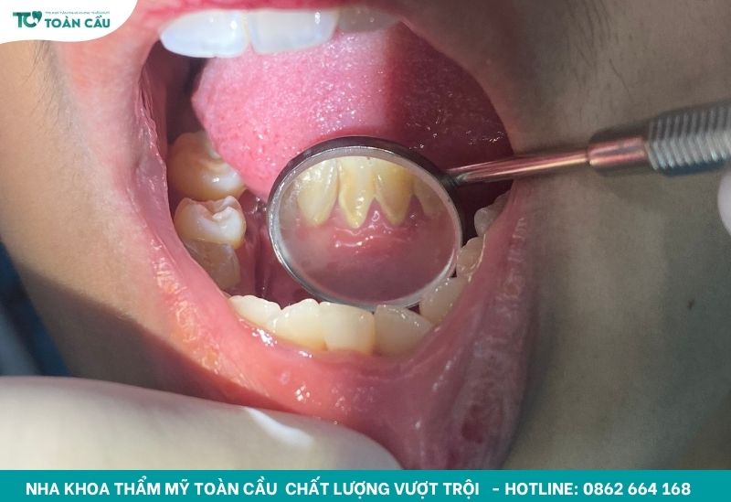 Cao răng là những mảng bám đã bị khoáng hóa