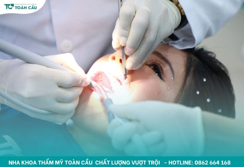 Cao răng nên được thực hiện định kỳ 3 - 6 tháng