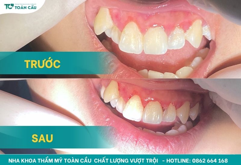 Hiệu quả lấy cao răng tại Nha khoa Thẩm mỹ Toàn Cầu