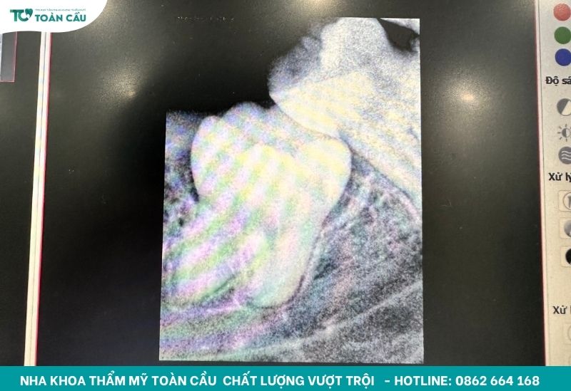 Răng khôn tiềm ẩn nhiều nguy cơ gây hại cho sức khỏe