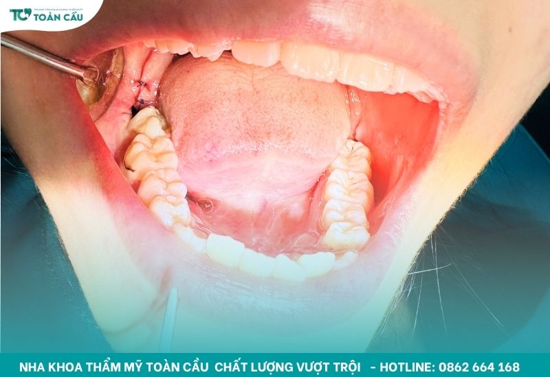 Nha khoa nhổ răng khôn mọc ngầm an toàn tuyệt đối