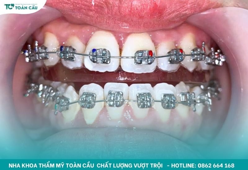 Nha khoa phối màu dây thun niềng răng Gò Vấp chuẩn gu Gen Z 7 Nha khoa phối màu dây thun niềng răng theo cung hoàng đạo