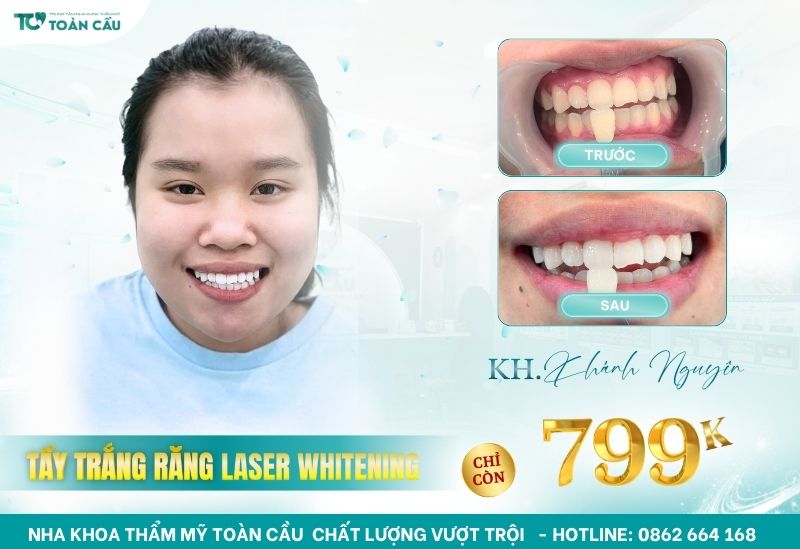 Nha khoa tẩy trắng răng bằng laser tại quận Gò Vấp 8 Địa chỉ tẩy trắng răng bằng laser uy tín tại quận Gò Vấp