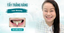 nha khoa tẩy trắng răng tại Gò Vấp