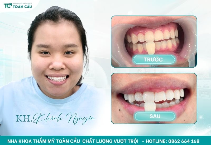 Khám phá nha khoa tẩy trắng răng tại Gò Vấp uy tín 8 Khách hàng Khánh Nguyên tẩy trắng răng tại Toàn Cầu