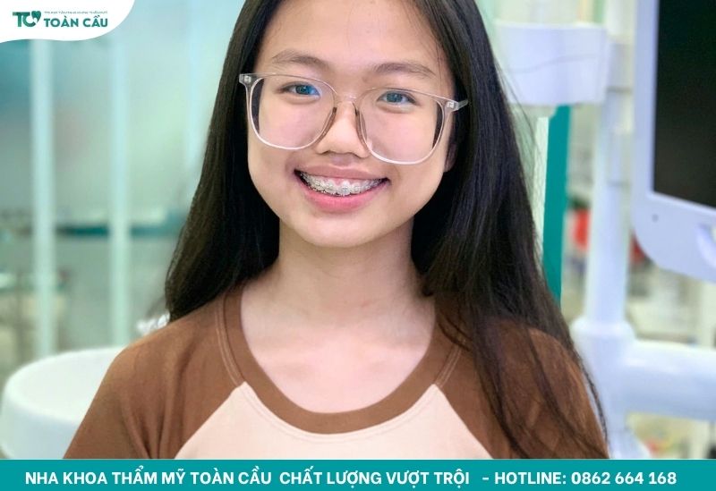 Nha khoa uy tín gần nhất với ưu đãi hấp dẫn cho mọi dịch vụ 6 Niềng răng mắc cài kim loại được nhiều bạn sinh viên lựa chọn