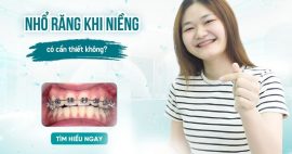 nhổ răng trong niềng răng