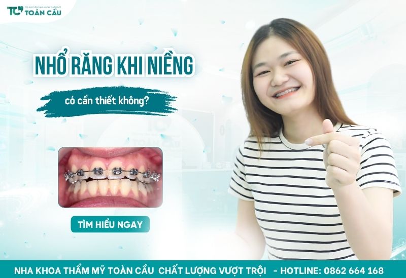 nhổ răng trong niềng răng
