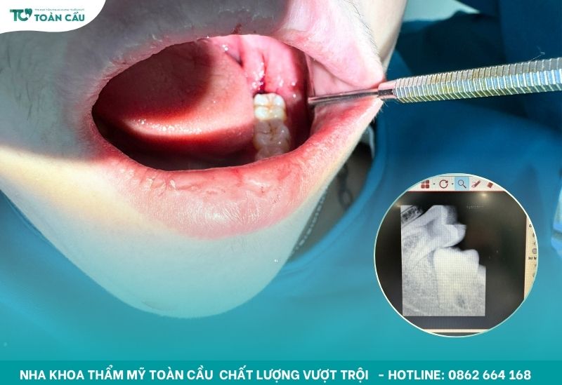Khi nào cần nhổ răng trong niềng răng? Không nhổ răng khôn được không? 6 Nên nhổ răng khôn khi niềng răng