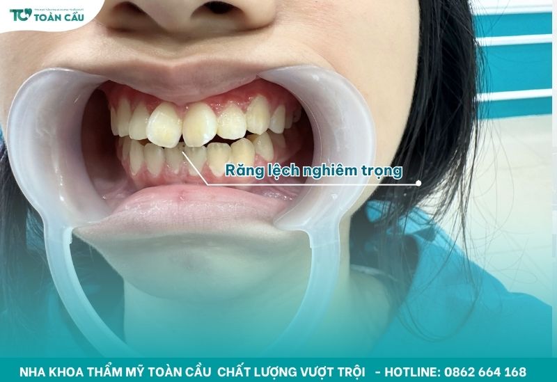 Niềng răng cho trẻ em tại Gò Vấp dễ chịu, không đau 5 Răng xấu có thể huỷ hoại tương lai con trẻ