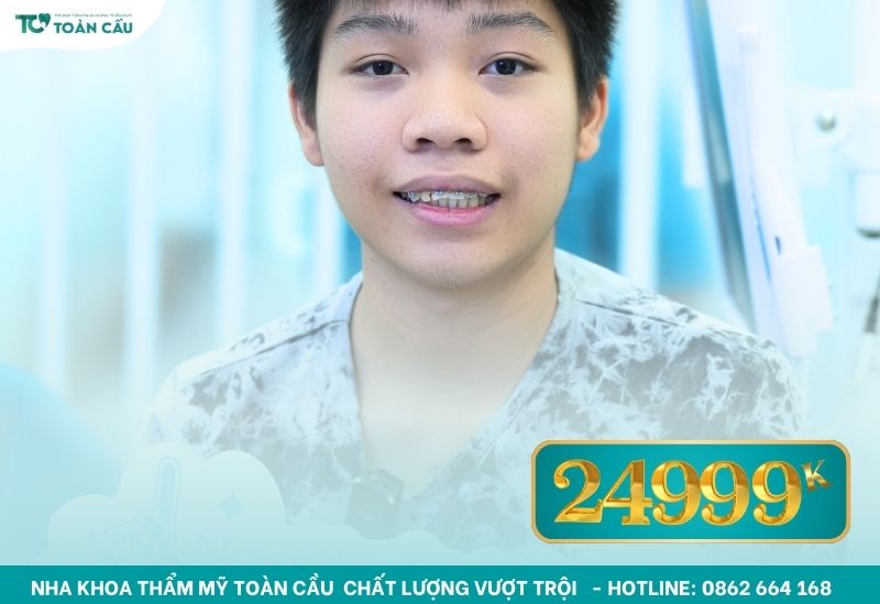 Niềng răng cho trẻ em tại Gò Vấp dễ chịu, không đau 8 Niềng răng cho trẻ em tại Gò Vấp chỉ 24tr999k