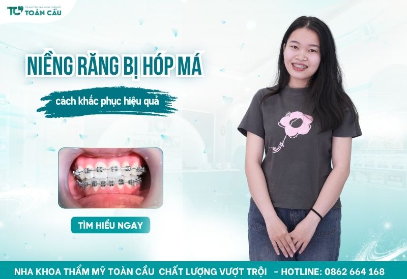 niềng răng có bị hóp má không