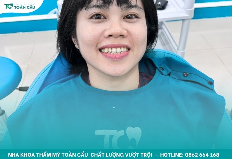 Niềng răng có bị hóp má không? Cách khắc phục hiệu quả 5 Thay đổi cấu trúc xương hàm dẫn đến hóp má