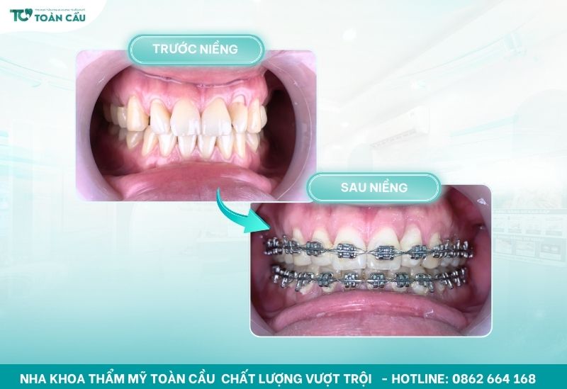 Niềng răng có giúp cải thiện phát âm không? Câu trả lời từ chuyên gia 6 Niềng răng giúp đưa răng về đúng vị trí