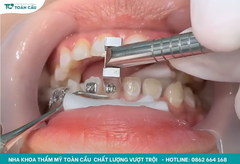 Nhu cầu niềng răng giá rẻ gần nhất ngày càng phổ biến