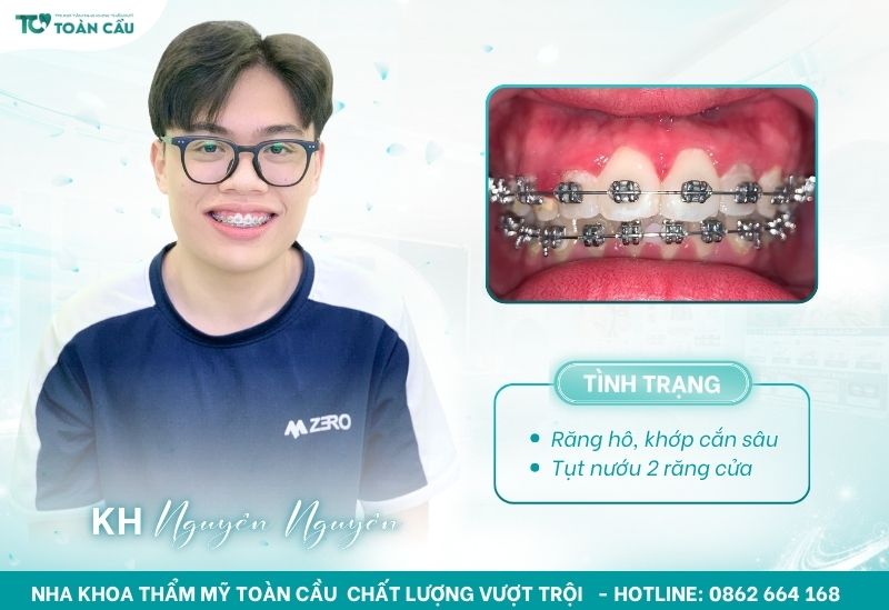 Khách hàng Nguyên Nguyên niềng răng giá rẻ tại Nha khoa Toàn Cầu