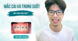 niềng răng mắc cài và niềng răng trong suốt