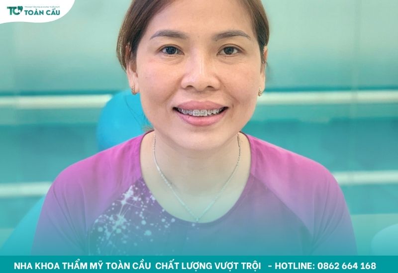 Ai cũng có thể dễ dàng sở hữu nụ cười đẹp, đều và tự tin